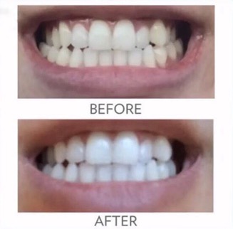 whitening_toothpaste_before _after